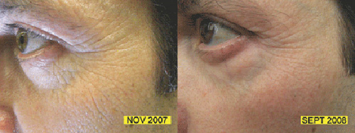 LED-подсветка способствует выработке эластина